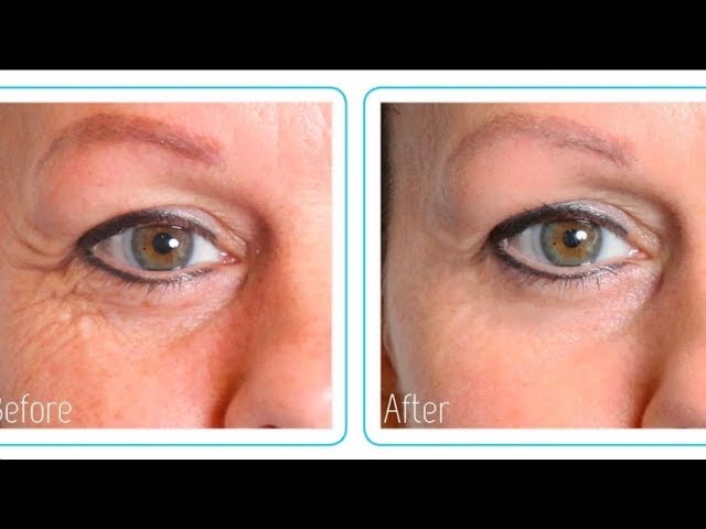 Hyaluronic Acid for Facial Contours: Filling Hollows and Smoothing Wrinkles